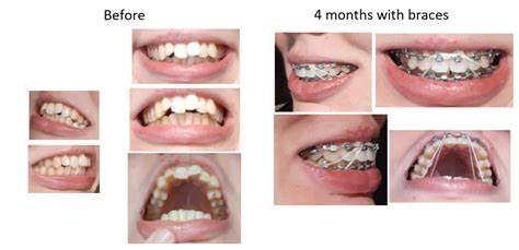 Fast Braces Overbite in 4 months : r/braces .